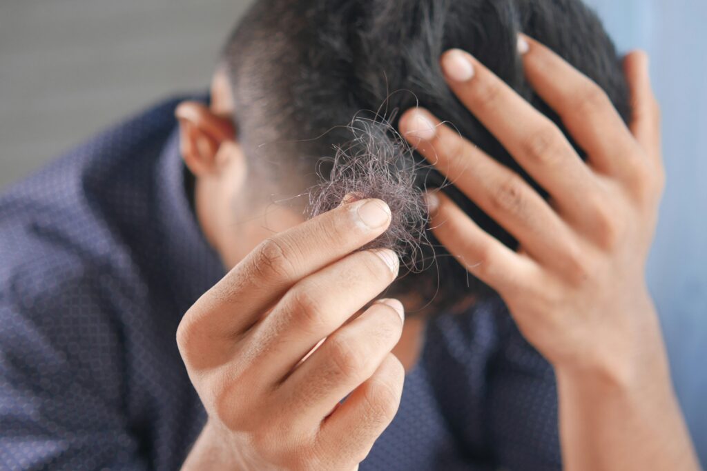 A man with hair loss holds up a clump of hair