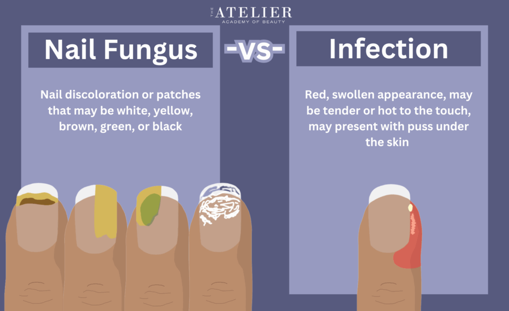 Diagram of illustrated examples of Nail Fungus vs. Infection. Nail Fungus- Nail discoloration or patches that may be white, yellow, brown, green, or black. Infection- Red, swollen appearance, may be tender or hot to the touch, may be present with puss under the skin