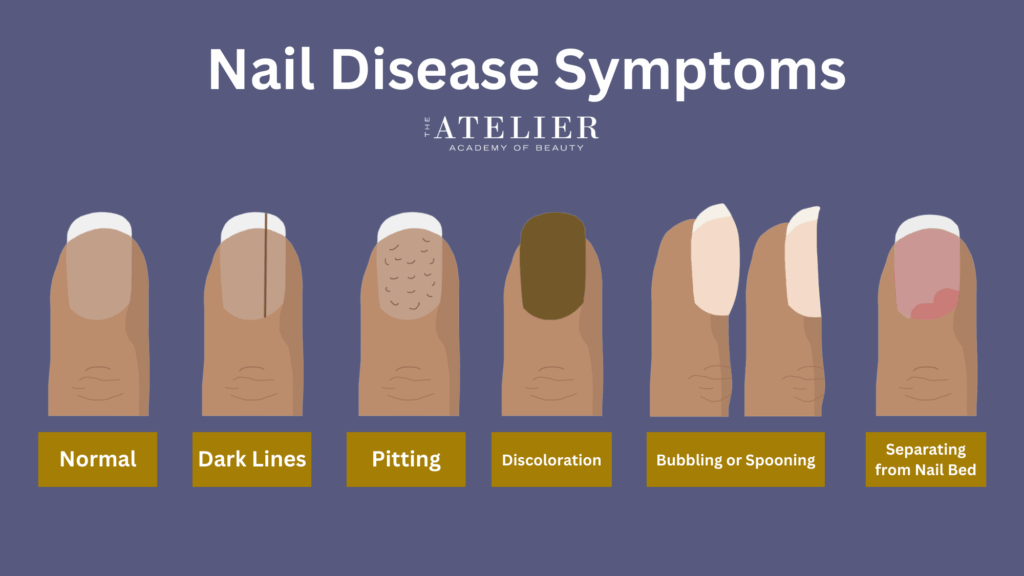 Diagram of illustrated examples of Nail Disease Symptoms: Normal Nail, Dark Lines, Pitting, Discoloration, Bubbling or Spooning, Separating from Nail Bed